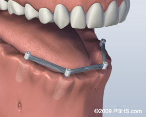 implant-supported dentures