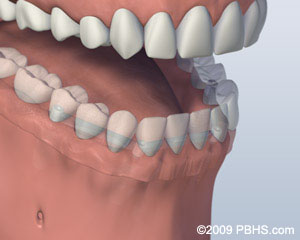 dentures placed on the implants for a secure hold