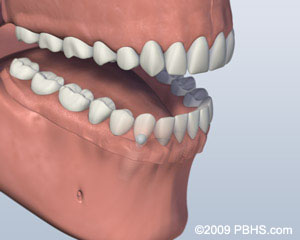 placing dentures on the four implants
