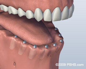 lower jaw all teeth missing with six implants for screw attachment denture