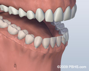 mouth with screw attachment denture affixed onto lower jaw by six implants