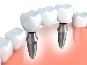 dental implants illustration