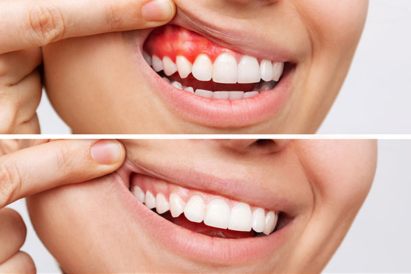 before anf after gum disease treatment